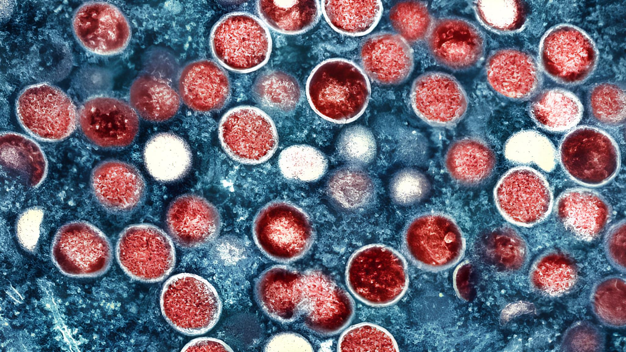 Portugal Contra o Mpox: Como o País Lida com a Sexta Maior Crise na Europa e o Que Isso Revela Sobre Saúde Global 3 Portugal Contra o Mpox: Como o País Lida com a Sexta Maior Crise na Europa e o Que Isso Revela Sobre Saúde Global Portugal Contra o Mpox: Como o País Lida com a Sexta Maior Crise na Europa e o Que Isso Revela Sobre Saúde Global